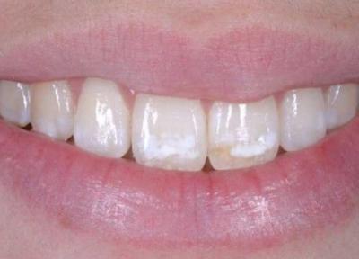 فلوراید بیش از حد چه خطراتی برای دندان ها دارد؟